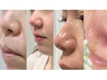 マイ フェア レディ(MY FAIR LADY)/毛穴の黒ずみ徹底除去