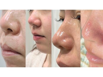 マイ フェア レディ(MY FAIR LADY)/毛穴の黒ずみ徹底除去