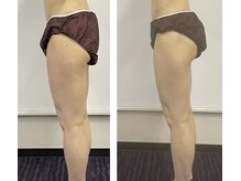 ヨサパーク ヴィヴァン(YOSAPARK Vivant)/パツパツ前ももをスッキリ細く！