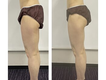 ヨサパーク ヴィヴァン(YOSAPARK Vivant)/パツパツ前ももをスッキリ細く！