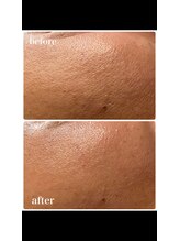 美バリ 新宿店(美BARI)/一回で毛穴の開き改善