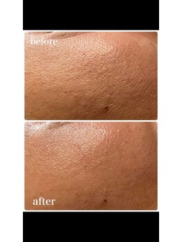 美バリ 新宿店(美BARI)/一回で毛穴の開き改善