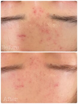 トゥモロー(TOMORROW)/ハーブピーリング/肌質改善