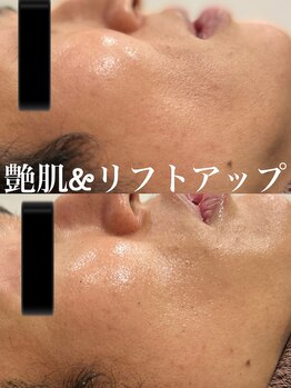 ツール(TOOL)/ハーブピーリング