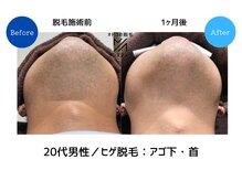 メンズアメリ/高知/メンズ脱毛/ヒゲ/全身/VIO