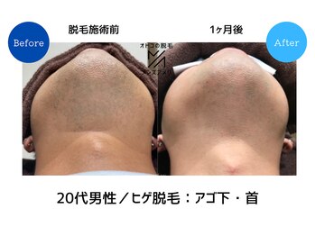 メンズアメリ/高知/メンズ脱毛/ヒゲ/全身/VIO