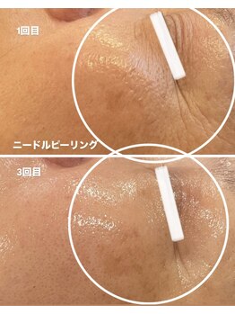 グレース(GRACE)/マイクロニードルピーリング