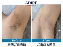 アディール(adire)の雰囲気(人気のワキ脱毛★ヒゲ脱毛/VIO脱毛/全身脱毛もオススメ♪)
