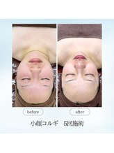 エスプレッソ(espresso,)/【小顔コルギ5回】