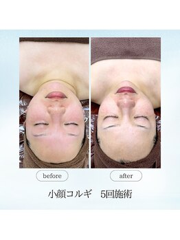 エスプレッソ(espresso,)/【小顔コルギ5回】