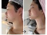 背中/首から造る小顔首長◎インディバ付★チタニウム80K×LDMエクソソーム