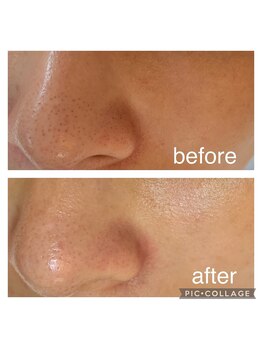 ウエカ(ueka)/効果がわかる!毛穴ケア☆