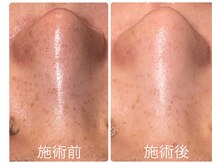 フォーチューン/ハーブ×シミの改善