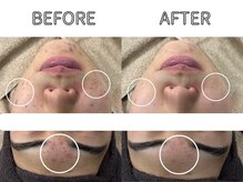 ライム 立川(LIME)/ハーブピーリング｜ニキビケア