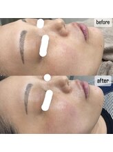 リノアンド(Lino&)/水光肌、剥かないピーリング