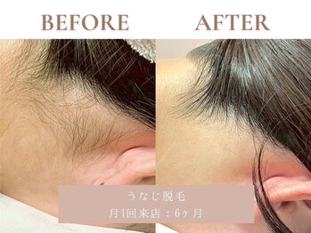 サエラ(SAERA)/うなじ脱毛【6回】