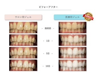 ラベージャ(La Bella)/【セルフホワイトニング】