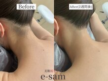 イーサム 高槻摂津富田店(e-sam)/丸ごと全身脱毛