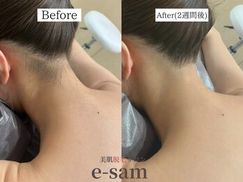 イーサム 高槻摂津富田店(e-sam)/丸ごと全身脱毛