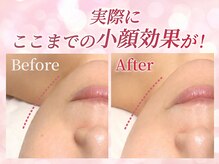 小顔専門店Lift(痩身・リフト)栄/小顔専門店Lift｜小顔施術