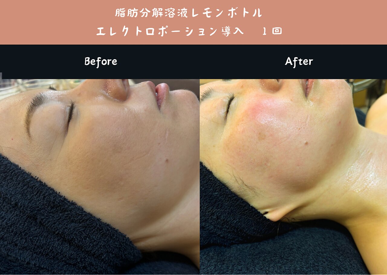 エレクトロポレーション　エステ 2025年最新】Yahoo!オークション -エレクトロポレーション