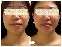 サロン ド ジョワ(salon de joie)/20代むくみ改善リフトアップ