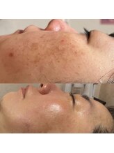 マヤヒメ(mayahime)/シミケア！40代5回の施術