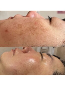 マヤヒメ(mayahime)/シミケア！40代5回の施術