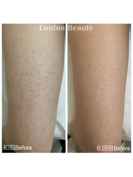 ルルボーテ(Loulou Beaute)/二の腕ザラつき