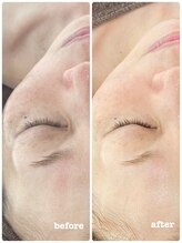 ピアーノ(PIANO)/エルモサハーブピーリング