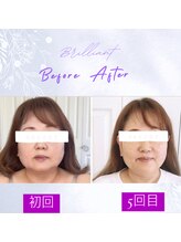 ブリリアント 西宮(Brilliant)/短期に集中で小顔に激変