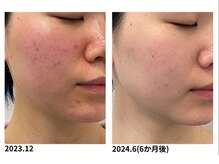 オーシャンブルー 福岡店(OCEAN BLUE フェイシャル&ボディ)/ニキビケア(グロウパールピール)