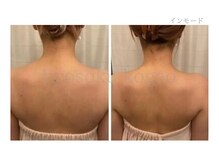 メディカルエステ 新宿店/＊肩×肩甲骨症例写真＊