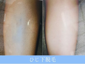 オーシャンブルー 大分店(OCEAN BLUE)/ひじ下脱毛