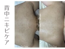 アニール(aniR)/ハーブピーリング/背中ケア