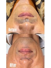 オアシス カナヤマ(Oasis kanayama)/【ヒゲ脱毛】