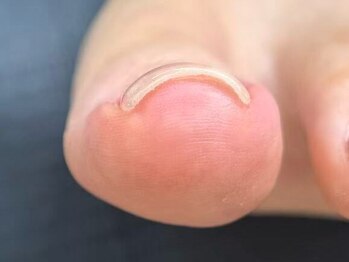 ネイルサロン ダオン(DAON)の写真/【巻き爪でお悩みの方にオススメ♪】巻き爪・フットケア・角質ケアが同時に楽しめるサロン！