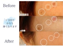 ディアスマイル(Dear.smile)/1~3回でかなり薄くなります