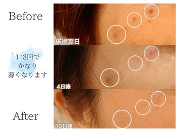 ディアスマイル(Dear.smile)/1~3回でかなり薄くなります