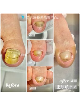 名古屋巻き爪専門Pro/肥厚爪4回目の変化