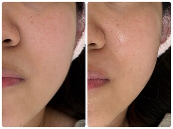 リュエル(RUELLE)/ダクトピール・ピーリング