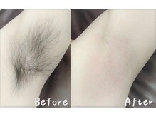 うるおい脱毛 ラルーチェ(LaLuce)/シュガーリングビフォーアフター