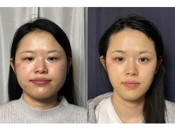 美容整体 アルマ/アルマ式小顔の効果