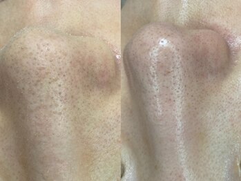 ヴィーヴ 京橋(vive)/【韓国式3D毛穴洗浄】