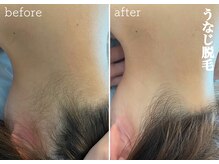 モノ(MONO)/【うなじ脱毛】