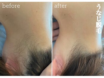 モノ(MONO)/【うなじ脱毛】