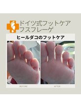 フスフレーゲ 学芸大学店/ヒールダコのお悩み