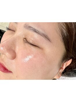 顔脱毛がしたい