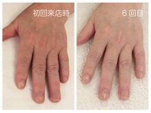 キレイテ 福岡天神店/肌荒れとゴツゴツ感