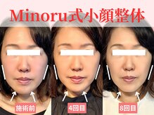 フレキシボディ(FlexiBody)/小顔施術ビフォーアフター #17